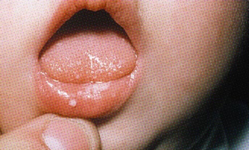 baby oral thrush picture