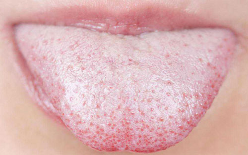 thrush-on-tongue-diagnosis