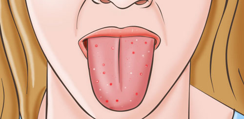 what does oral thrush look like? is it contageous?